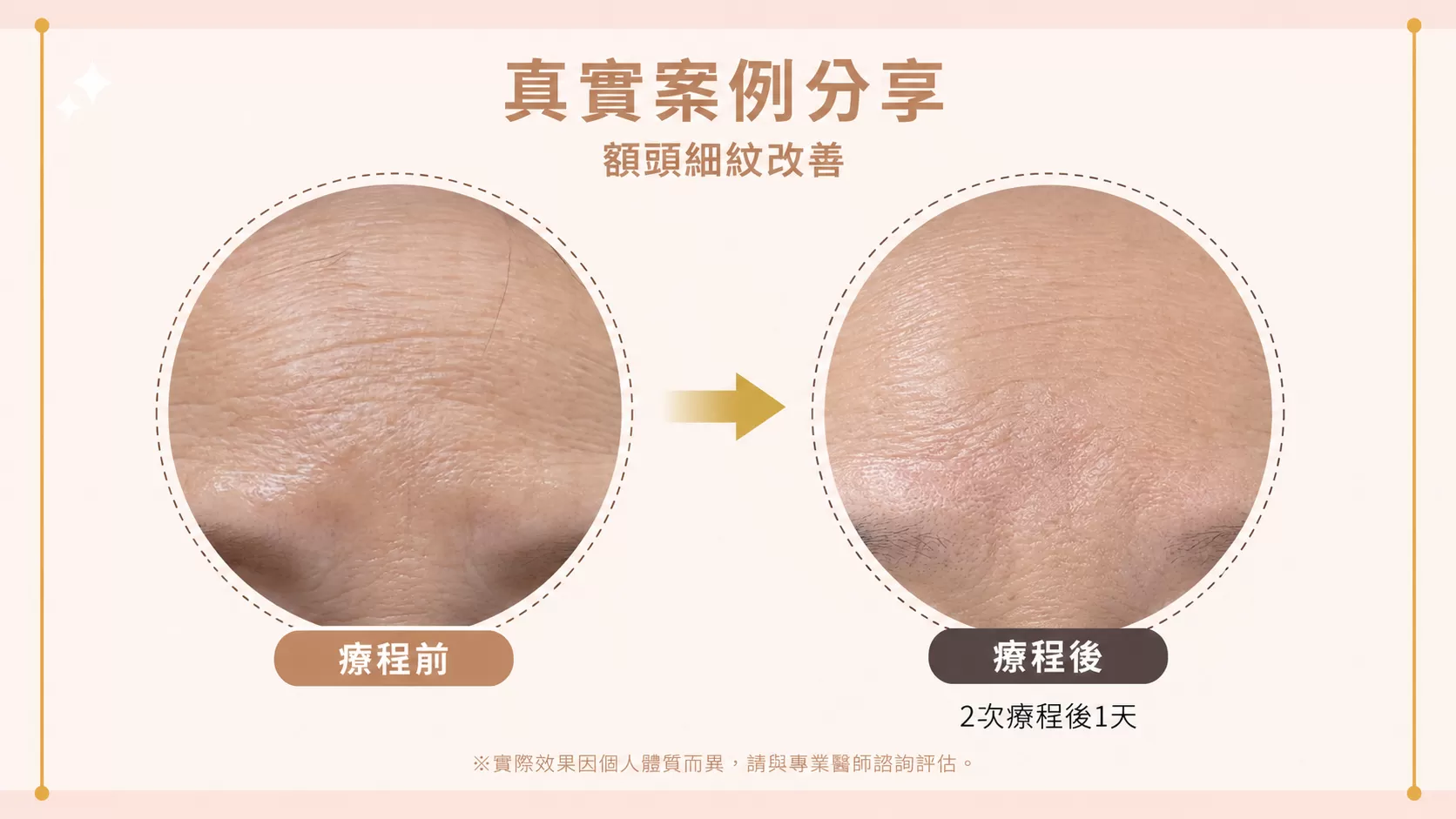彈力針療程後膚感改善，肌膚光澤細緻度提升示意圖