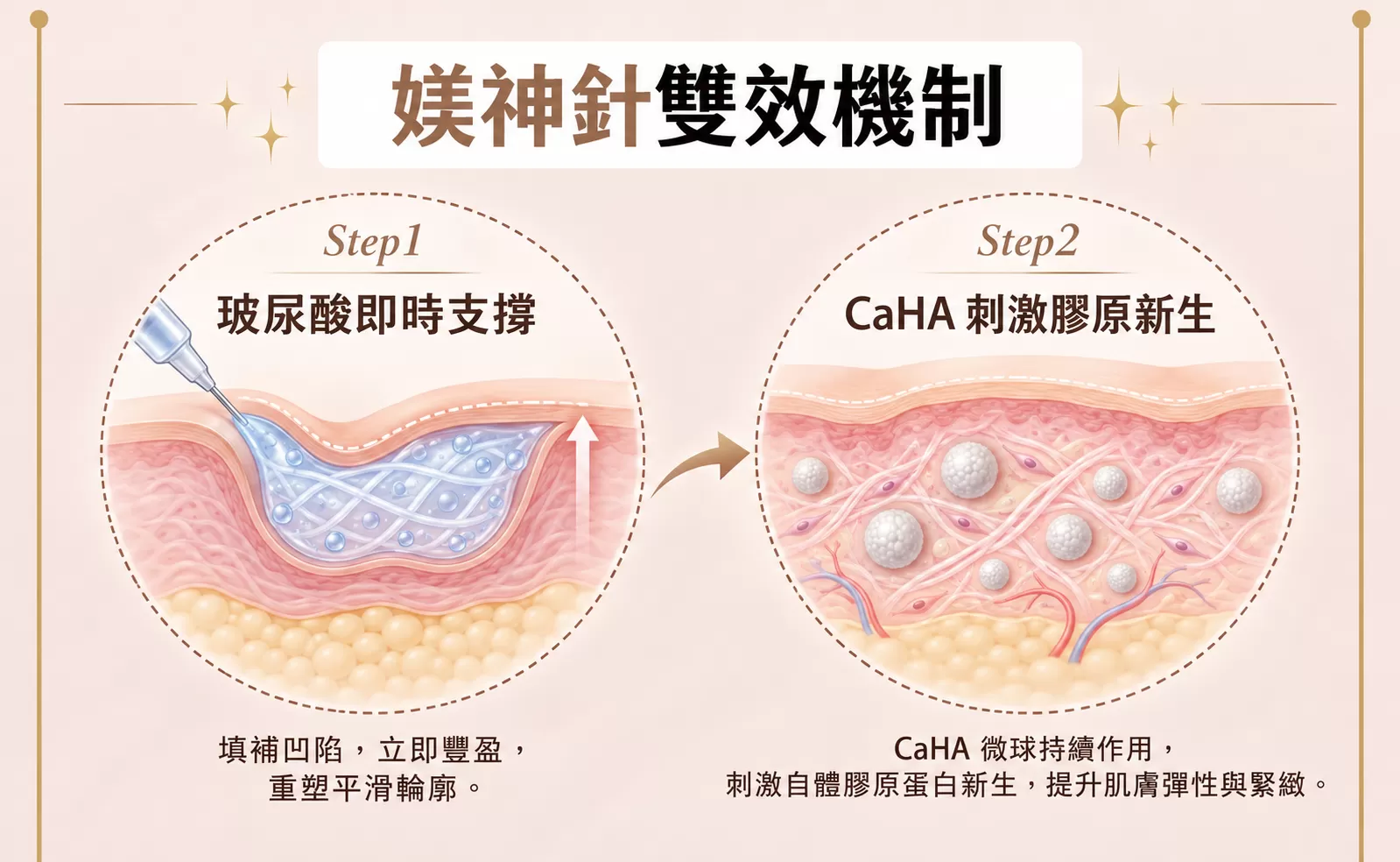 媄神針雙效機制示意圖,Step1 玻尿酸即時支撐、Step2 CaHA 刺激膠原新生