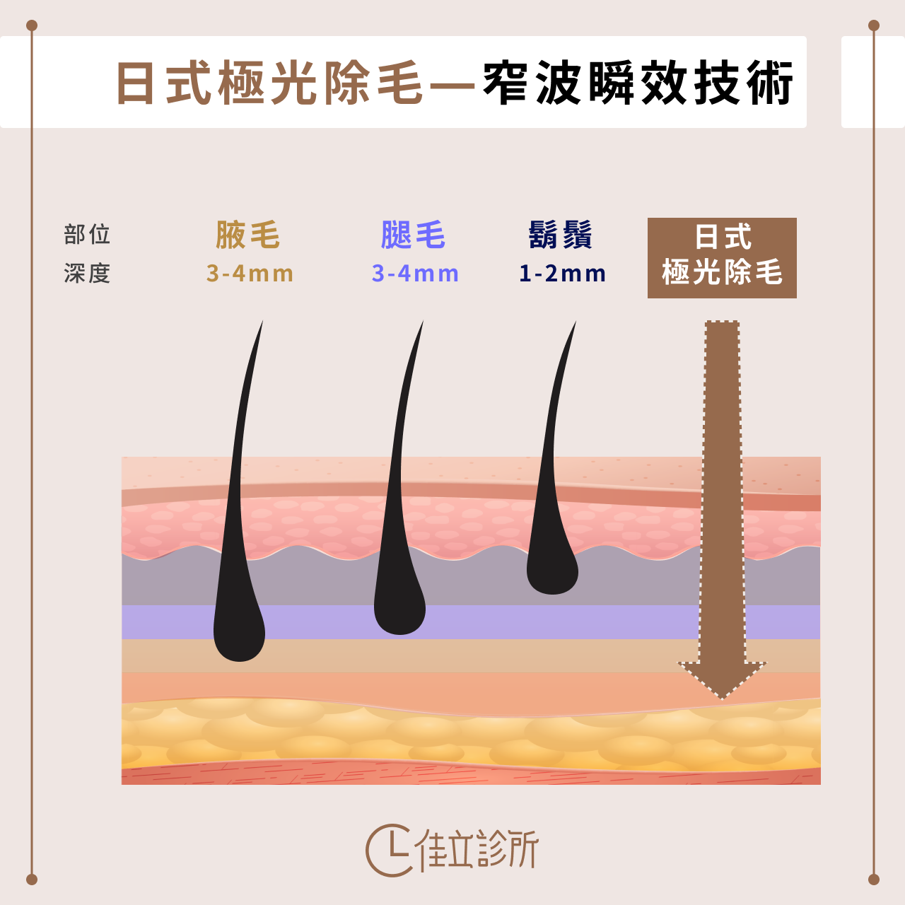 日式極光除毛─窄波瞬效技術