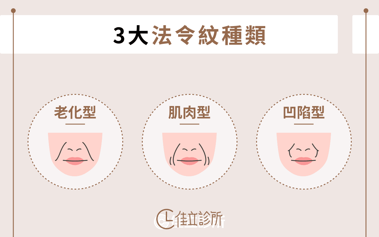 3大法令紋種類介紹