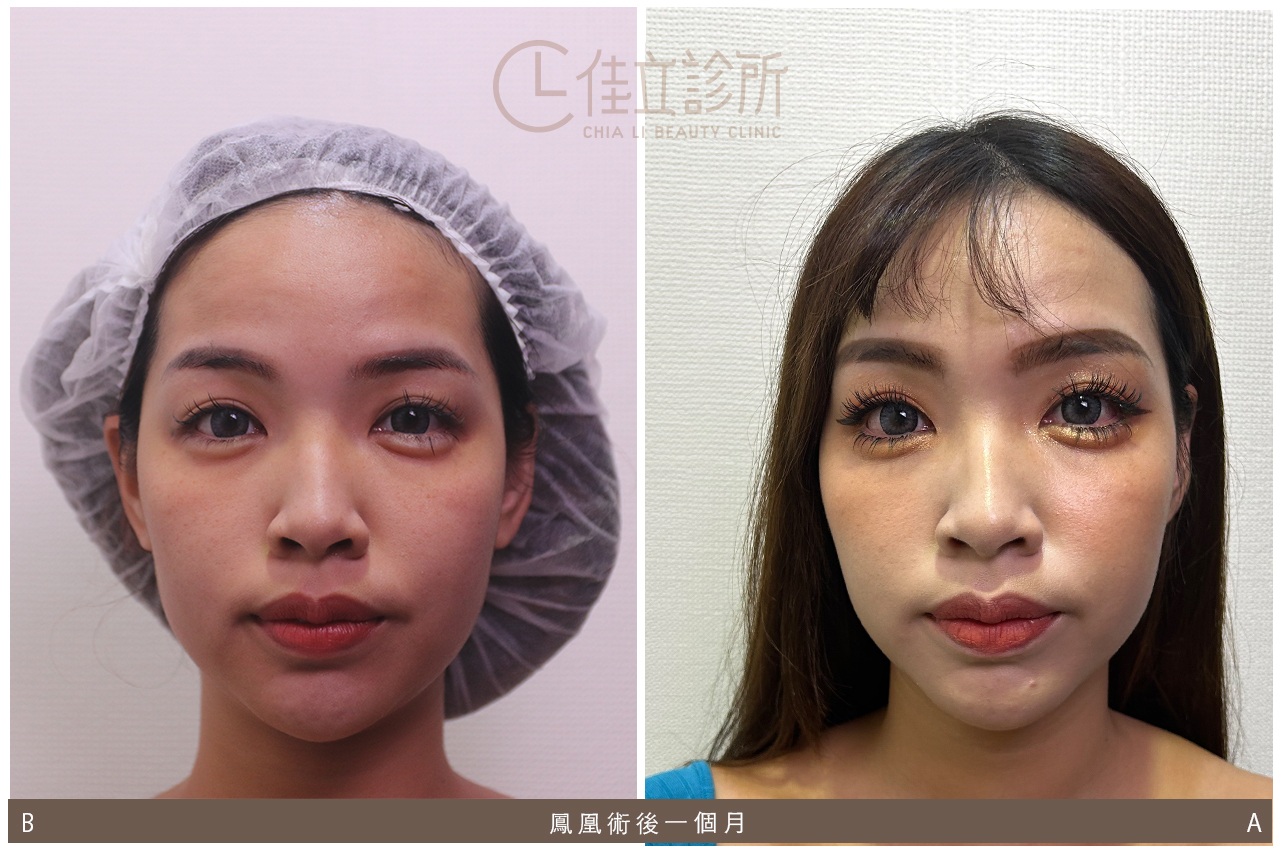 淚溝醫美改善方式 3：鳳凰電波