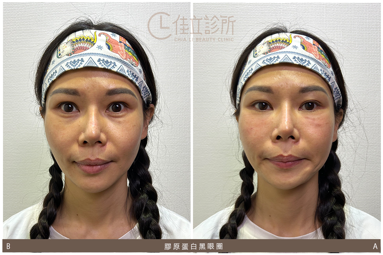 淚溝醫美改善方式 2：施打膠原蛋白針