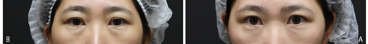 淚溝醫美改善方式 1：施打玻尿酸