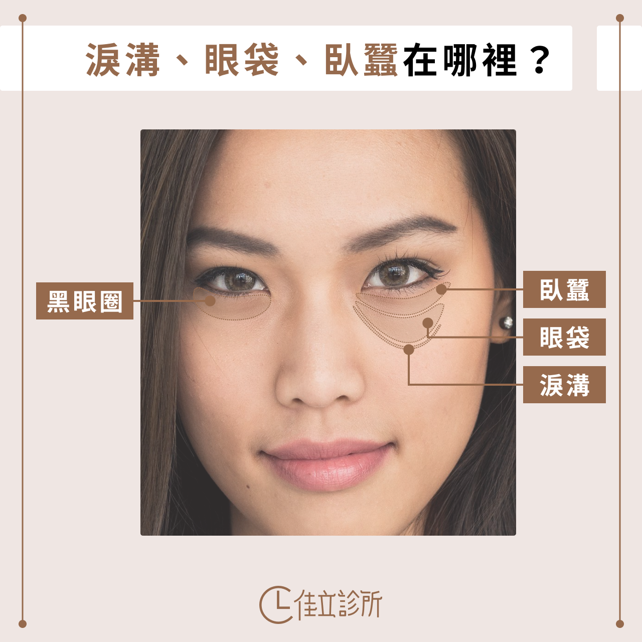 淚溝眼袋臥蠶黑眼圈差別