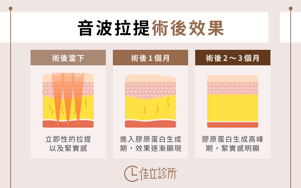 音波拉提術後效果