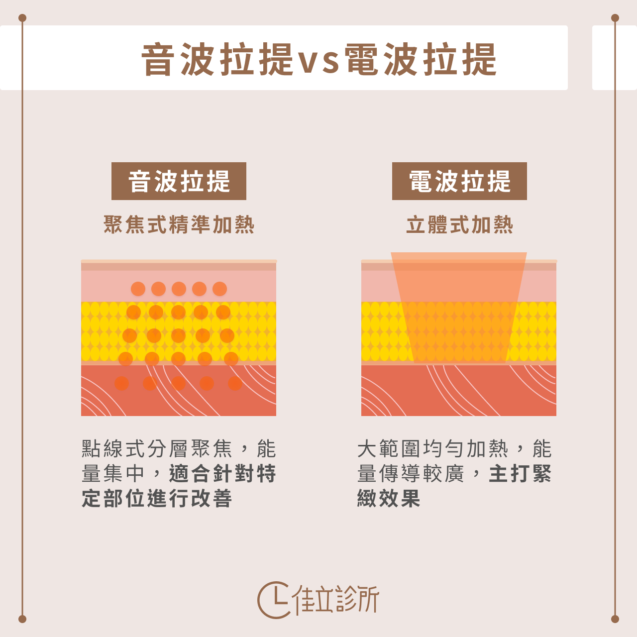 音波拉提電波拉提比較